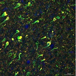 Immunofluorescence de cerveau humain atteint d'Alzheimer